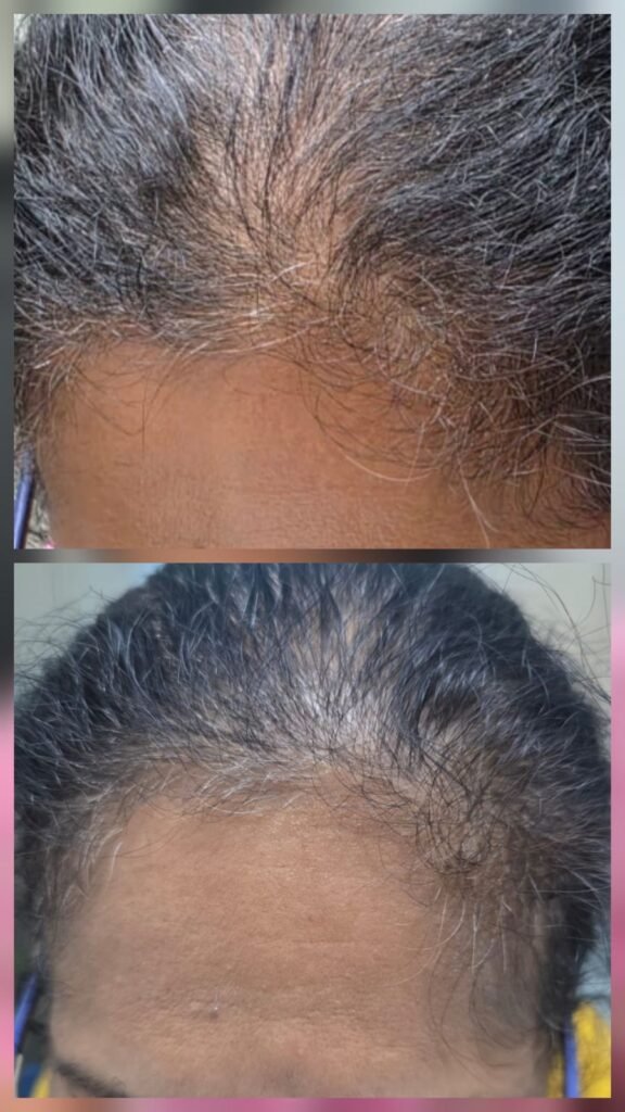 HAIR REGROWTH TREATMENT IN WANWADI FOR THINNING HAIR SOLUTIONS 🌱