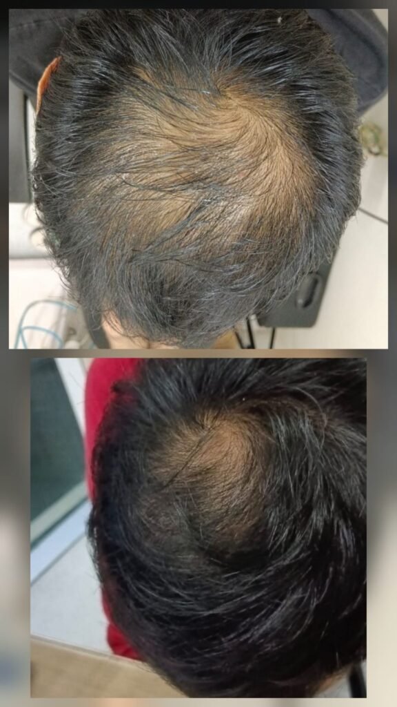 HAIR REGROWTH TREATMENT IN WANWADI FOR THINNING HAIR SOLUTIONS 🌱